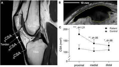 Mechanical and Material Tendon Properties in Patients With Proximal Patellar Tendinopathy